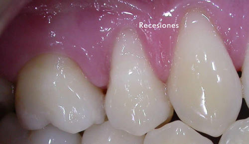 Imagen de dientes superiores con recesión de la encía