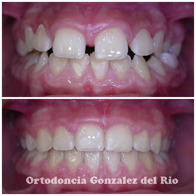 Diastema dental ,antes y despues