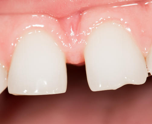 diastema dental