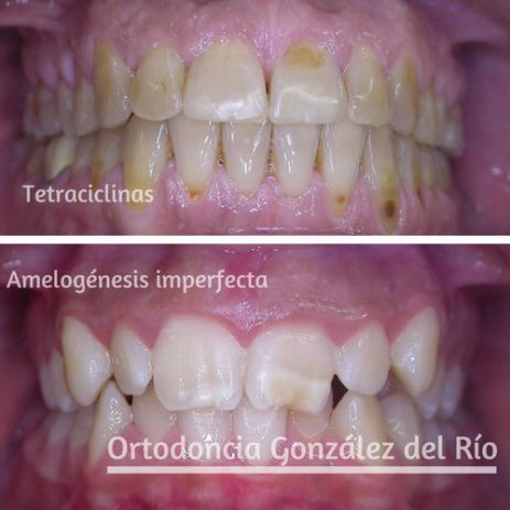 dientes amarillos,causas internas