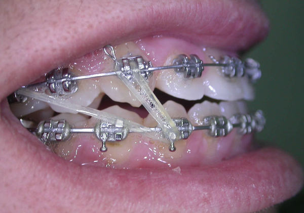 elasticos en la duracion de un tratamiento de ortodoncia