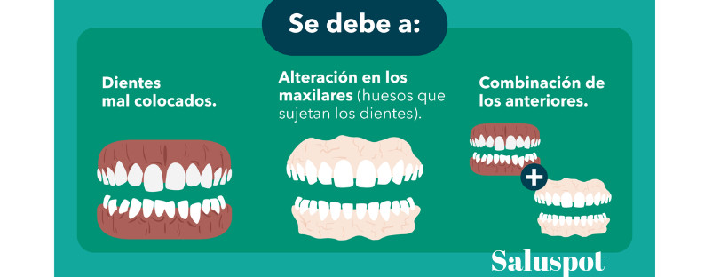 maloclusiones y como su tipo influye en cuanto tiempo  dura  la ortodoncia