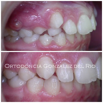 Protector bucal: ortodoncia y deporte - Ortodoncia González del Río