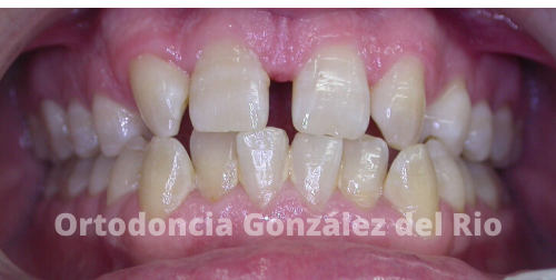 dientes separados porque hay agenesia de laterales