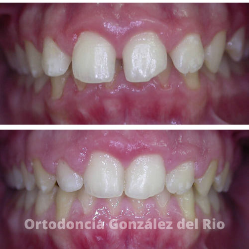 Dos imagenes ,al principio y al final del tratamiento ortodoncico,con dientes diastemados.La causa es porque los dientes superiores cubren mucho a los inferiores
