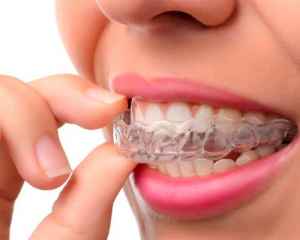 Alineadores transparentes para tratamiento de ortodoncia invisible