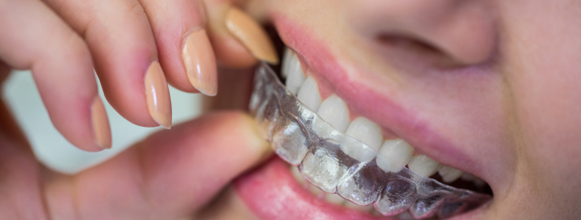 Invisalign Marbella, la solución invisible para una sonrisa perfecta.